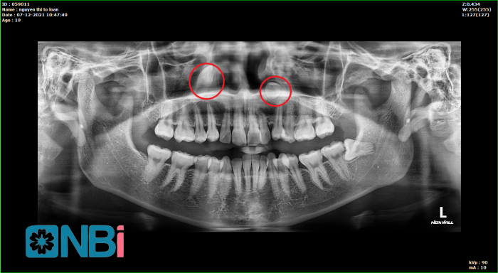 Phim chụp CT Conebeam 3D răng ngầm tại nha khoa NBi.