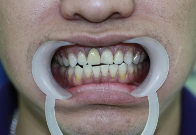 Cách bảo vệ và giữ gìn răng sứ để không bị đen viền nướu