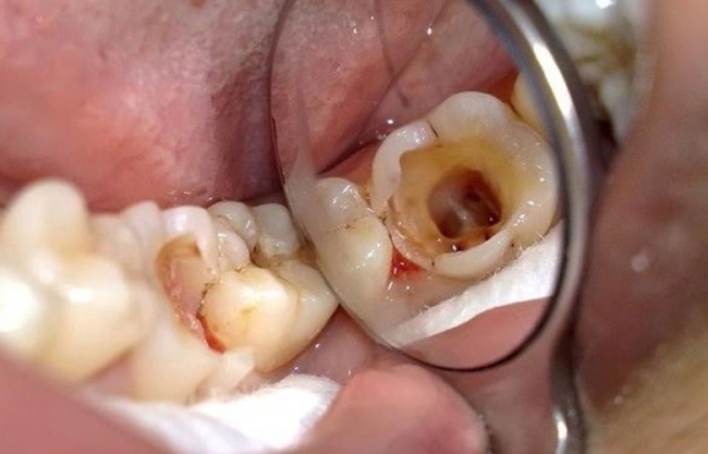 Các bệnh thường gặp ở tủy răng