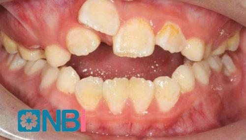 Làm sao phân biệt được răng sữa và răng vĩnh viễn?