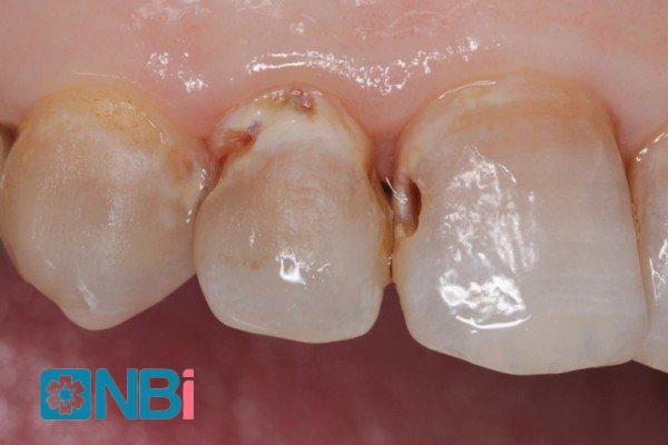 Sâu kẽ răng cửa có cần điều trị?