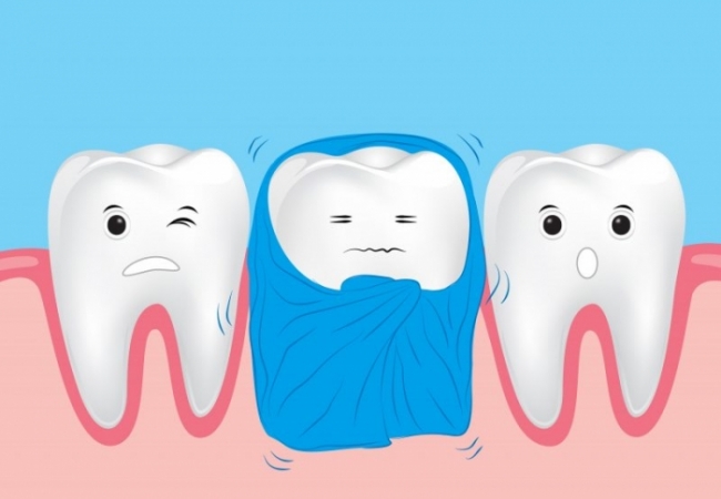 Tủy răng bị hoại tử do viêm tủy mãn tính